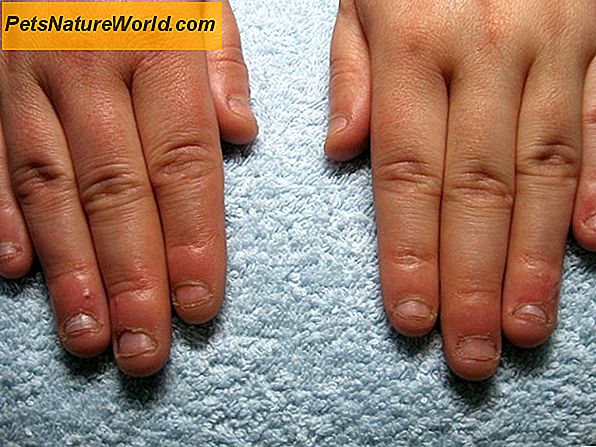 Kůže Miliární dermatitida