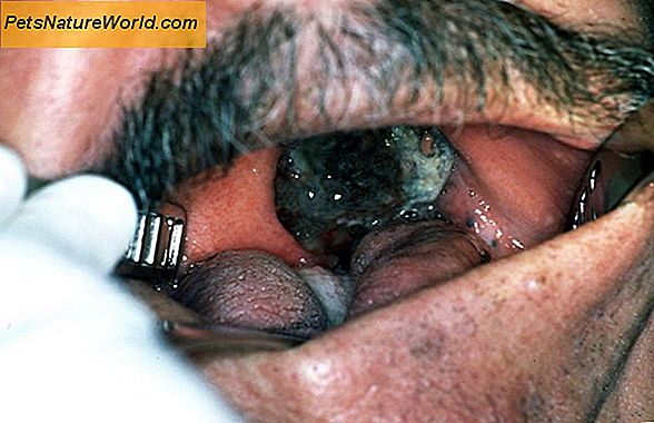 Oral oral melanom