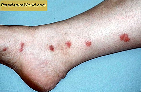 Mensen met huidschilfers behandelen Allergieën voor allergieën