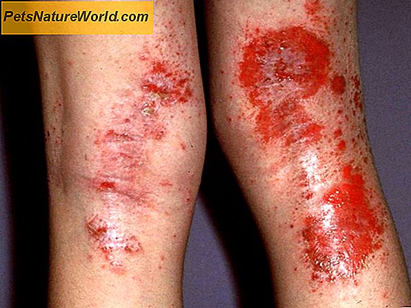 Voorkomen van infecties van de huid van de huid