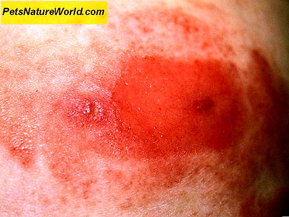 6 Oorzaken van huidirritatie door de huid