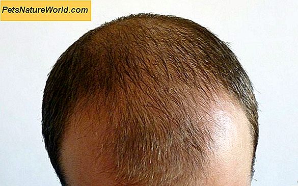 Психогена алопеција: губитак косе косе због повлачења